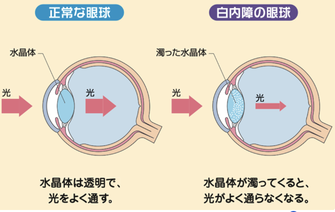 白内障と通常の眼球の違いについて