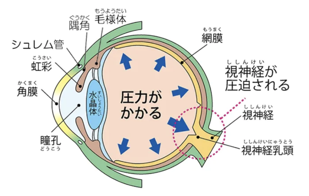 緑内障の症状の画像