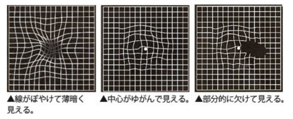 アムスラーチャート検査の画像