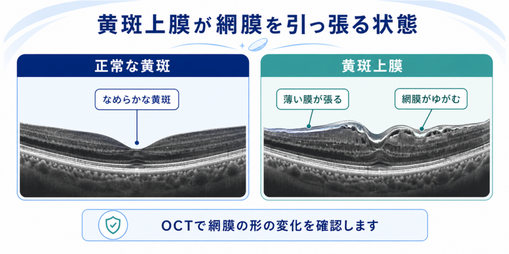 黄斑上膜が網膜を引っ張る状態の図解。正常な黄斑(なめらかな黄斑)と、黄斑上膜(薄い膜が張り網膜がゆがむ状態)の比較およびOCTによる確認について解説