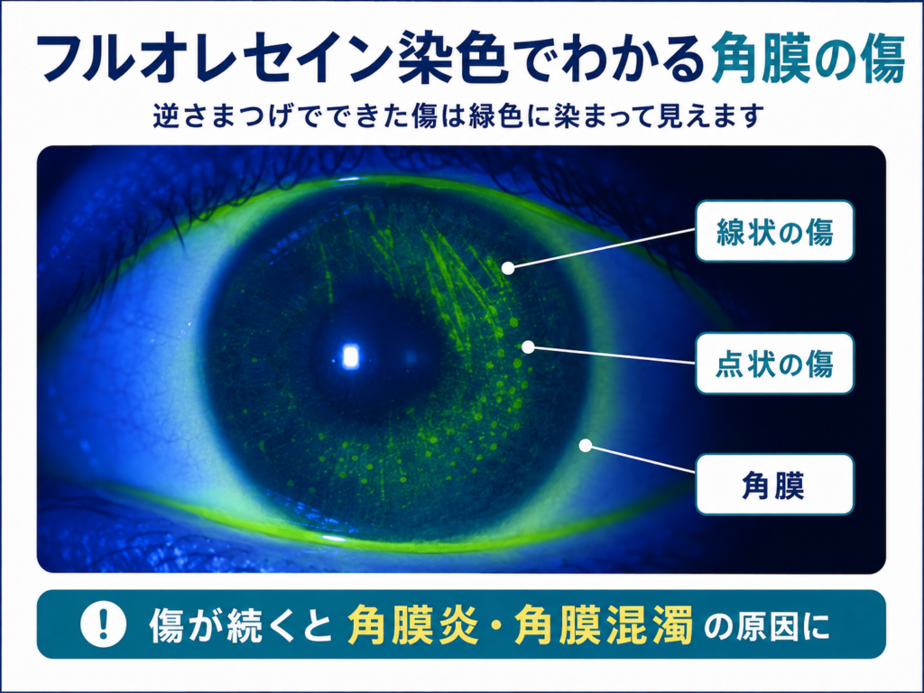 フルオレセイン染色でわかる角膜の傷の解説画像。逆さまつげでできた傷が緑色に染まって見える眼球の写真と、線状の傷・点状の傷・角膜の指図。「傷が続くと角膜炎・角膜混濁の原因に」という注意喚起のテキスト