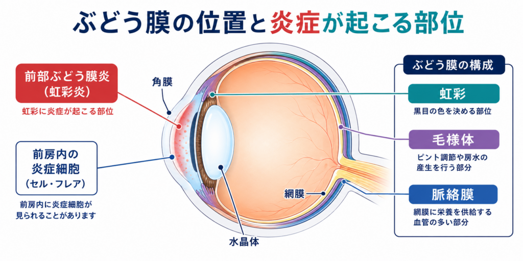 ぶどう膜の位置と炎症が起こる部位の図解。ぶどう膜を構成する「虹彩」「毛様体」「脈絡膜」の位置と、虹彩に炎症が起きる前部ぶどう膜炎（虹彩炎）、前房内の炎症細胞（セル・フレア）の発生部位を示した眼球構造の解説イラスト｜京橋いしづち眼科（京橋駅徒歩1分・東京駅徒歩6分）