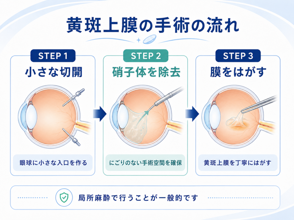 黄斑上膜(硝子体手術)の手術手順と流れ。1. 小切開(白目に小さな穴を開ける)、2. 硝子体の除去、3. 黄斑上膜の剥離(膜をきれいに取り除く)の3ステップを解説