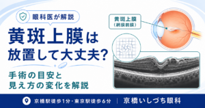 黄斑上膜は放置して大丈夫？手術の目安と見え方の変化を解説｜京橋いしづち眼科（京橋駅徒歩1分・東京駅徒歩6分）